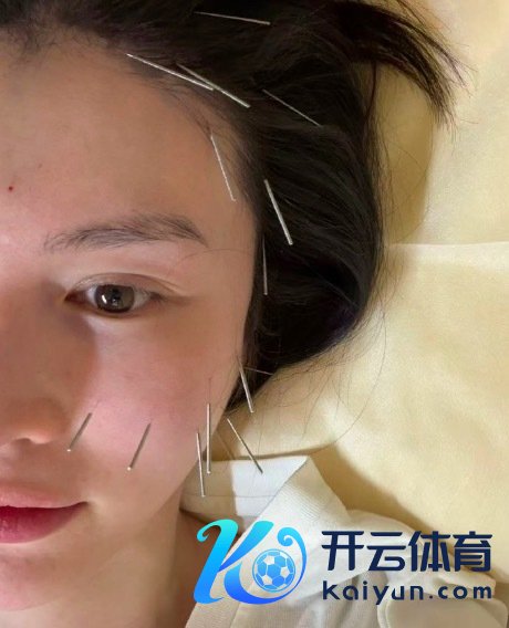 何穗作念了面部擢升针灸 当然抗衰新神态